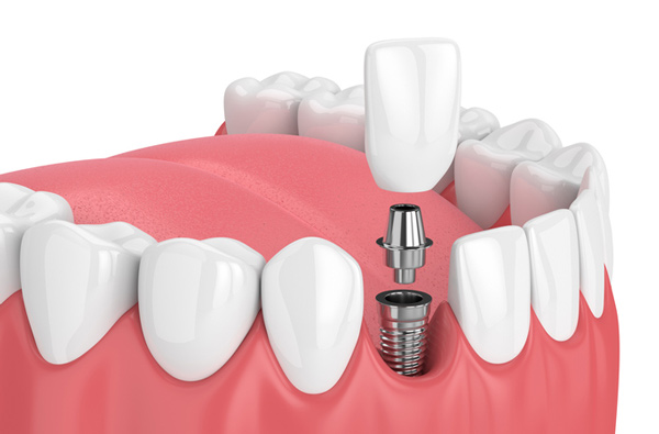 implant dentures procedure
