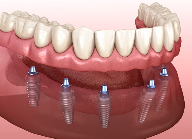 implant retained dentures problems